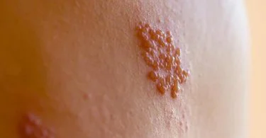 The significant difference between herpes zoster and genital herpes shows that zoster herpes is a viral infection triggered by the reactivation of the varicella-zoster virus. In contrast, genital herpes is a viral infection triggered by the herpes simplex virus 2. Herpes zoster and genital herpes are two various kinds of viral infections. Herpes zoster is also referred to as shingles and takes place due to the reactivation of the varicella-zoster virus that naturally triggers chicken pox. On the contrary, genital herpes is triggered by herpes simplex 2, a kind of herpes simplex virus.