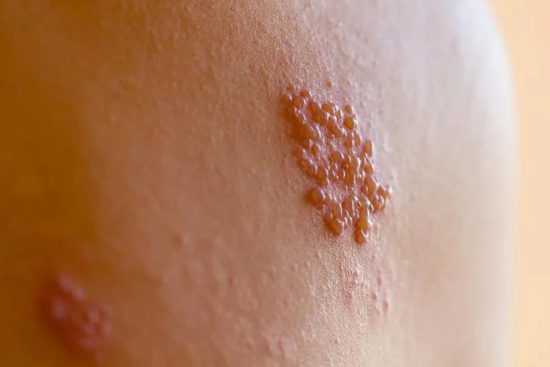The significant difference between herpes zoster and genital herpes shows that zoster herpes is a viral infection triggered by the reactivation of the varicella-zoster virus. In contrast, genital herpes is a viral infection triggered by the herpes simplex virus 2. Herpes zoster and genital herpes are two various kinds of viral infections. Herpes zoster is also referred to as shingles and takes place due to the reactivation of the varicella-zoster virus that naturally triggers chicken pox. On the contrary, genital herpes is triggered by herpes simplex 2, a kind of herpes simplex virus.