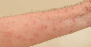 The significant difference between scabies and urticaria is based on their description. Scabies is described as skin rashes as a result of a mite referred to as Sarcoptes scarbiei. Urticaria, on the other hand, is described as a skin rash resulting from an allergic response to food or something individuals have touched. Skin rashes are usually red, dry, bumpy, inflamed, itchy, and painful.