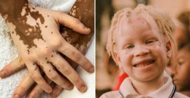 Difference Between Leucoderma and Albinism
