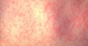 The significant difference between measles and mumps indicates that measles is a viral infection triggered by measles morbillivirus while mumps is a viral infection triggered by mumps orthorubulavirus. Measles and mumps are two viral infections that are positively infectious. The causative mechanism of these two viral infections is part of the same family known as paramyxoviridae. Their indications are comparable. However, their prolonged-term impacts are opposites. These two infections are very regular in younger kids. However, measles and mumps are managed via the same vaccine described as the MMR vaccine. The MMR vaccine is a vaccine that fights against measles, rubella, and mumps.
