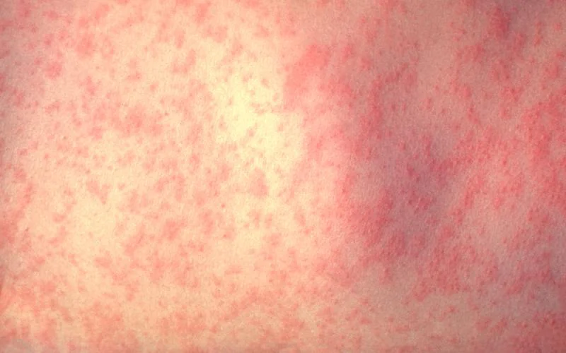 The significant difference between measles and mumps indicates that measles is a viral infection triggered by measles morbillivirus while mumps is a viral infection triggered by mumps orthorubulavirus. Measles and mumps are two viral infections that are positively infectious. The causative mechanism of these two viral infections is part of the same family known as paramyxoviridae. Their indications are comparable. However, their prolonged-term impacts are opposites. These two infections are very regular in younger kids. However, measles and mumps are managed via the same vaccine described as the MMR vaccine. The MMR vaccine is a vaccine that fights against measles, rubella, and mumps.