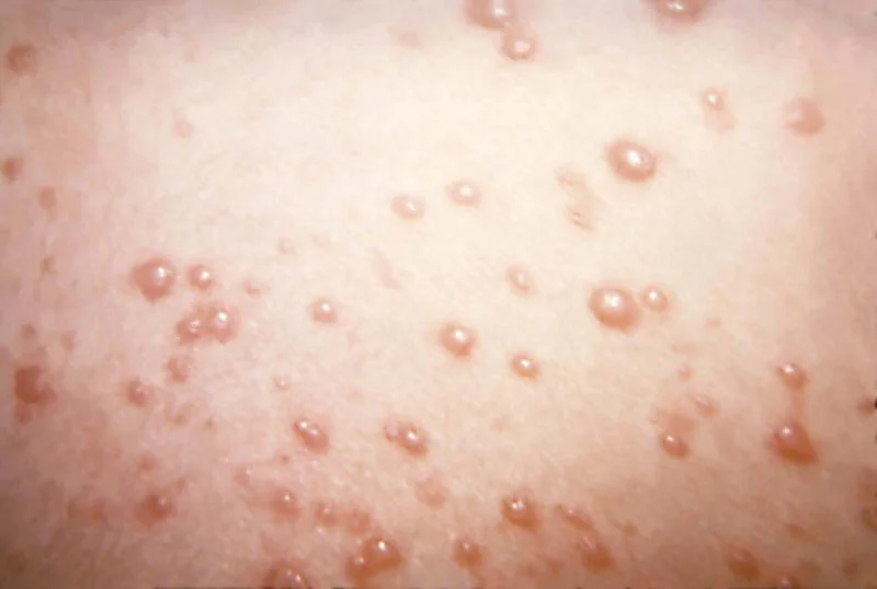 Chickenpox and hand, foot and mouth ailment, both triggered by a viral infection, share some common traits and trigger the diagnostic disorder. But so many traits of the two ailments are remarkably different. The significant difference between chicken pox and hand foot and mouth ailment is the herpes virus triggers that chicken pox, whereas the picorna virus triggers hand, foot and mouth ailment. This writing highlights the disparity between chicken pox and hand, foot and mouth ailments with concern to the organism accountability, clinical image, intricacies, diagnosis, and treatment.