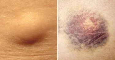 Difference Between Lipoma and Hematoma