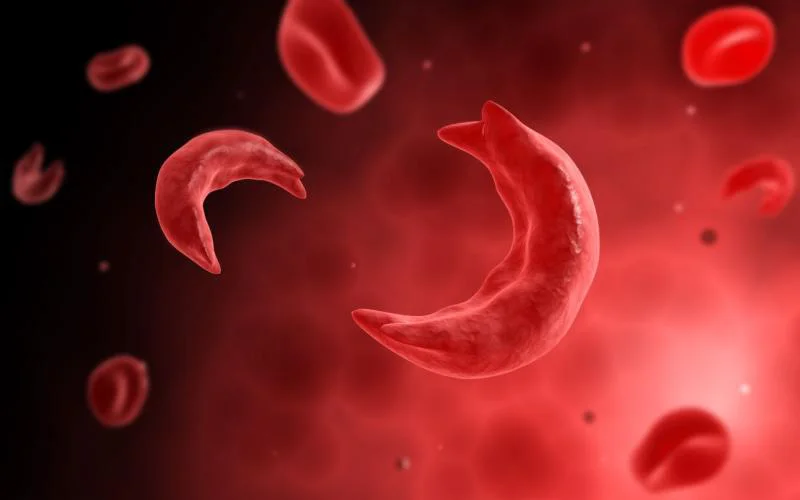 Sickle cell disease is a typical genetic hemoglobinopathy triggered by a point adaptation in beta-globin that stimulates the polymerization of deoxygenated haemoglobin resulting in red cell contortion, hemolytic anaemia, ischemic tissue deterioration, and microvascular blockage.