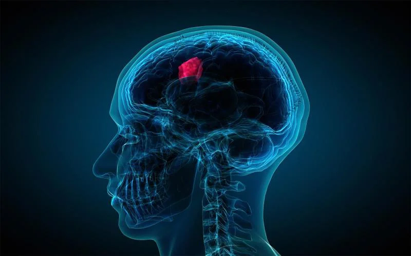 The significant difference between meningioma and glioma shows that meningioma is a tumour that begins from meninges encircling the brain and the spinal cord. Glioma, on the other hand, is a tumour that begins from glial cells in the spinal cord or in the brain.